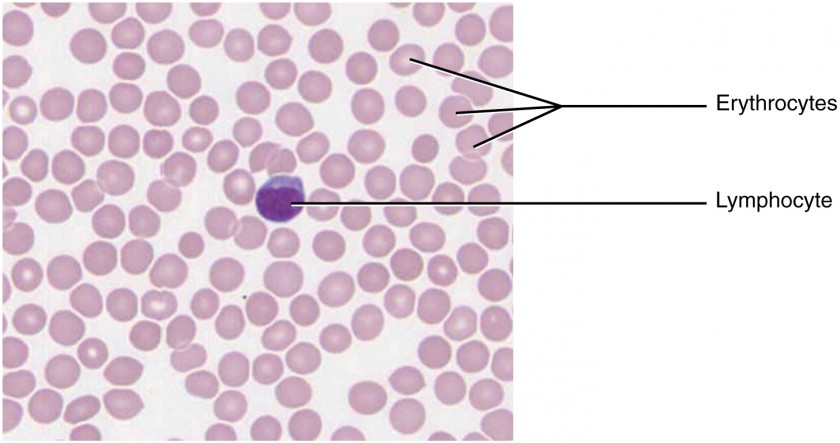 This micrograph of a blood smear shows a group of red blood cells and a single white blood cell. The red cells are small discs which have a slight depression at their centers with no nuclei present. The white blood cell is larger and more darkly stained and has a large, prominent nucleus that is also darkly stained.