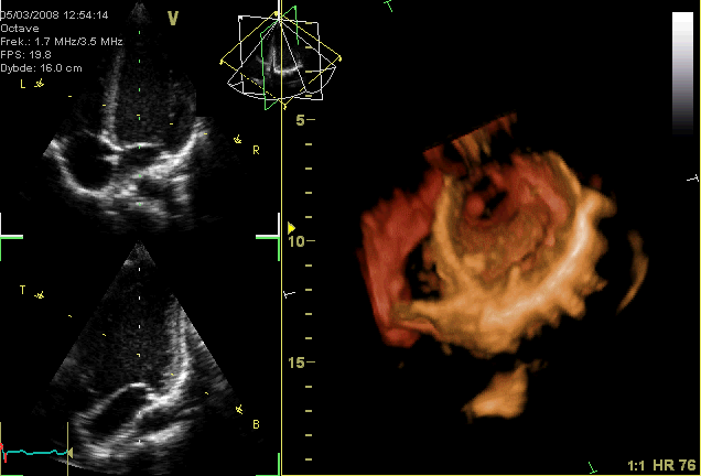 GIF-animation showing a moving echocardiogram; a 3D-loop of a heart viewed from the apex, with the apical part of the ventricles removed and the mitral valve clearly visible. Due to missing data the leaflet of the tricuspid and aortic valve is not clearly visible, but the openings are. To the left are two standard two-dimensional views taken from the 3D dataset