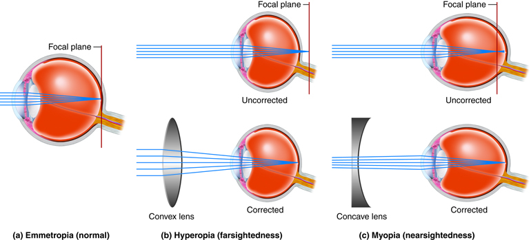 Correcting abnormalities in light refraction in the eye.