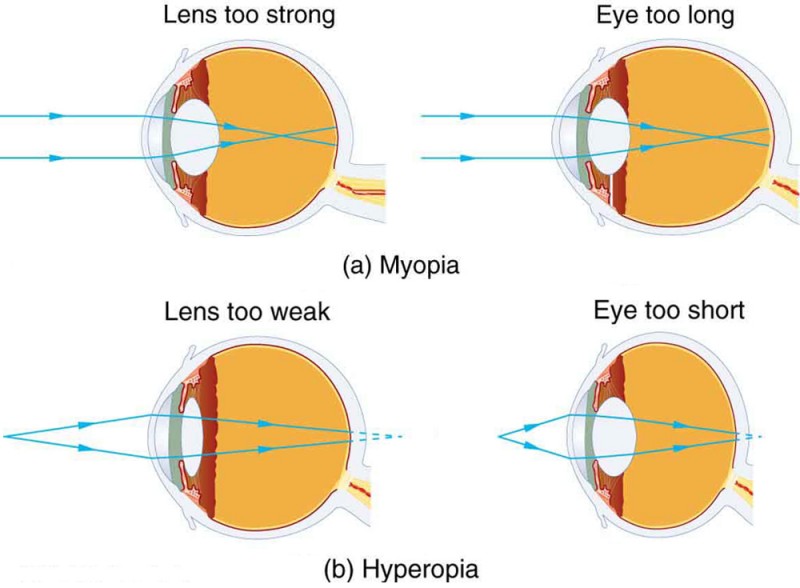 Why Does Hyperopia Happen