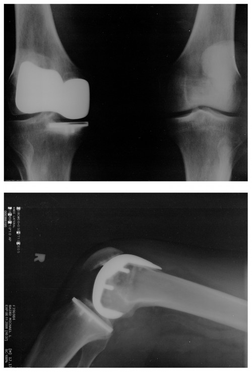 Two x rays of an artificial knee replacement are shown.