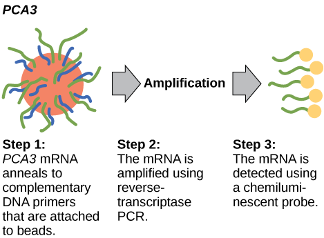 The PCA3 test occurs in three steps. In step one, PCA3 mRNA anneals to complementary DNA primers that are attached to beads. In step two, the mRNA is amplified using reverse-transcriptase PCR. In step three, the mRNA is detected using a chemiluminescent probe.