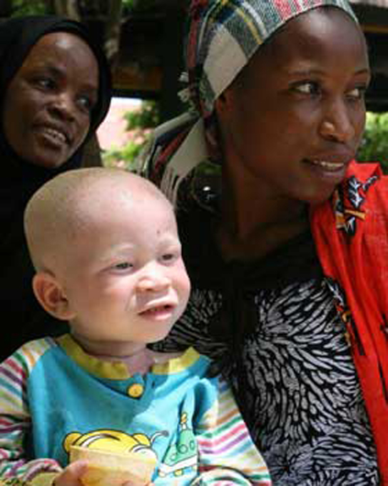 Photo shows an albino child with his black mother.