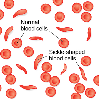 An illustration shows round and sickle-shaped blood cells.