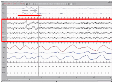 Chart A is a polysonograph with the period of rapid eye movement (REM) highlighted.