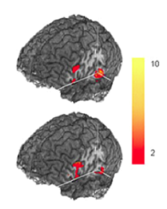 Two images of brain fMRI scans. The top image shows red areas of activation in three different regions on the back of the head, and he bottom scan shows activation in two similar areas. A bar showing the intensity of the activation from red (2) to yellow (10) is shown next to the brain scans.